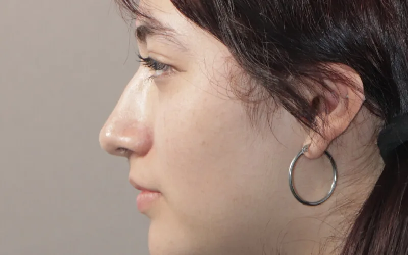 Evelyn · Perfil derecho · Antes