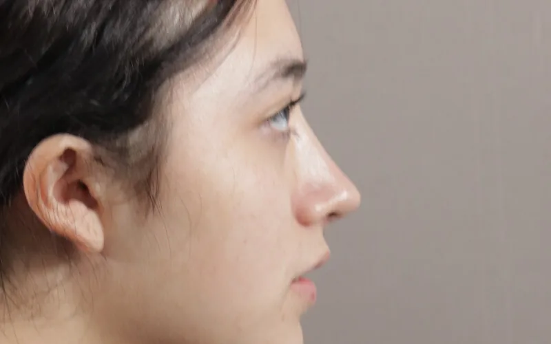 Evelyn · Perfil izquierdo · Después