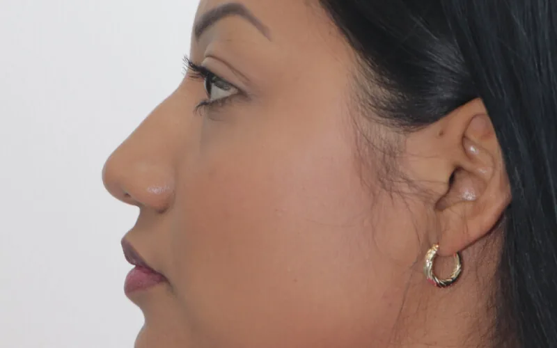 Thelma · Perfil derecho · Antes