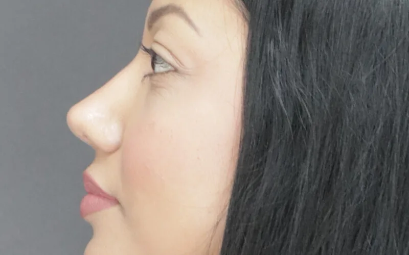 Thelma · Perfil derecho · Después