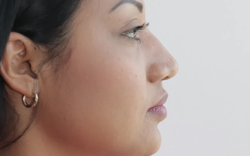 Thelma · Perfil izquierdo · Antes