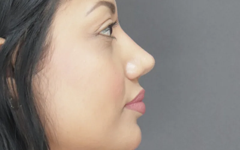 Thelma · Perfil izquierdo · Después